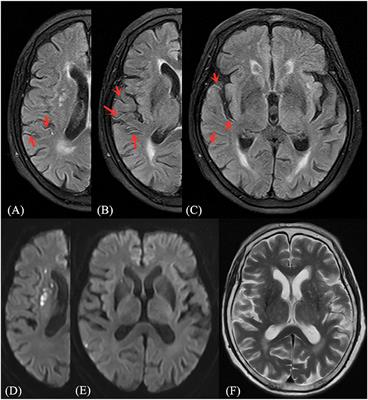 Application of FLAIR Vascular Hyperintensity-DWI Mismatch in Ischemic Stroke Depending on Semi-Quantitative DWI-Alberta Stroke Program Early CT Score